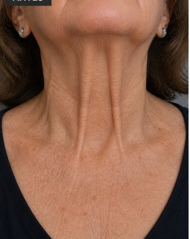 Cuello — antes