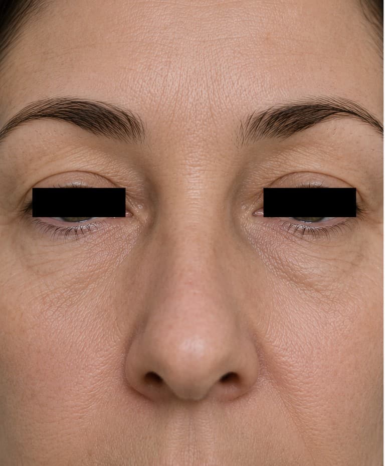 Contorno de ojos — antes