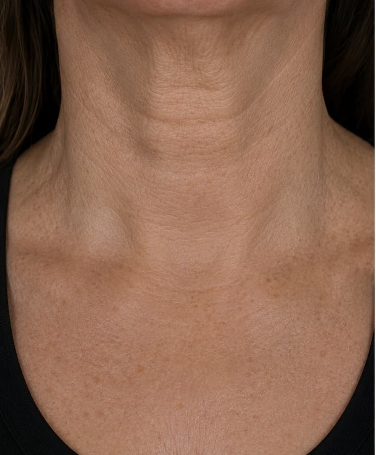 Cuello — antes
