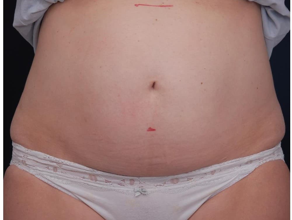 Abdomen — vista frontal — antes