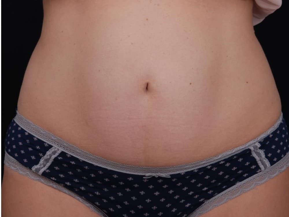 Abdomen — vista frontal — después