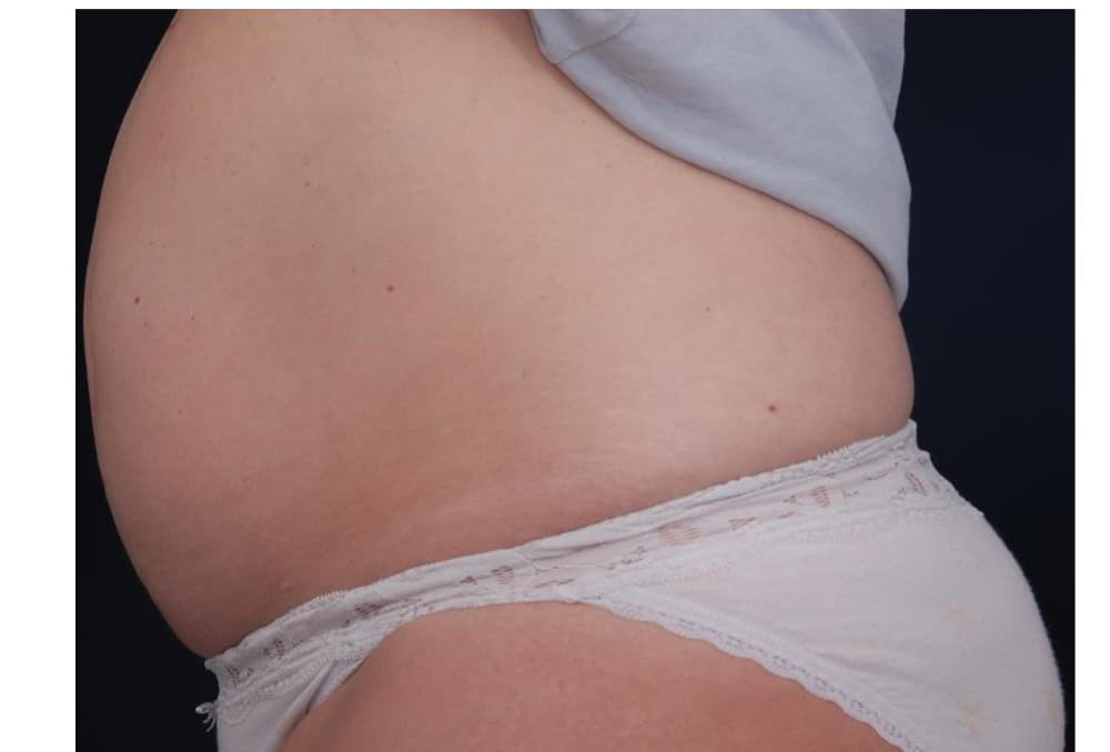 Abdomen — perfil lateral — antes