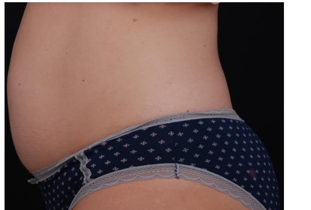 Abdomen — perfil lateral — después