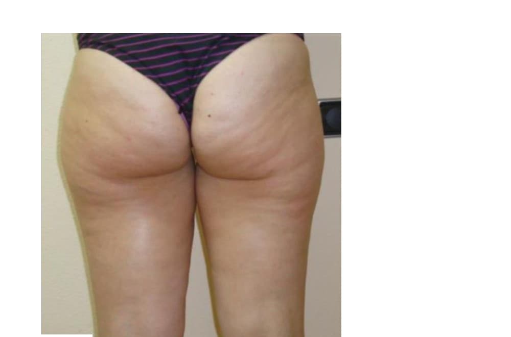 Glúteos — reducción de celulitis — después